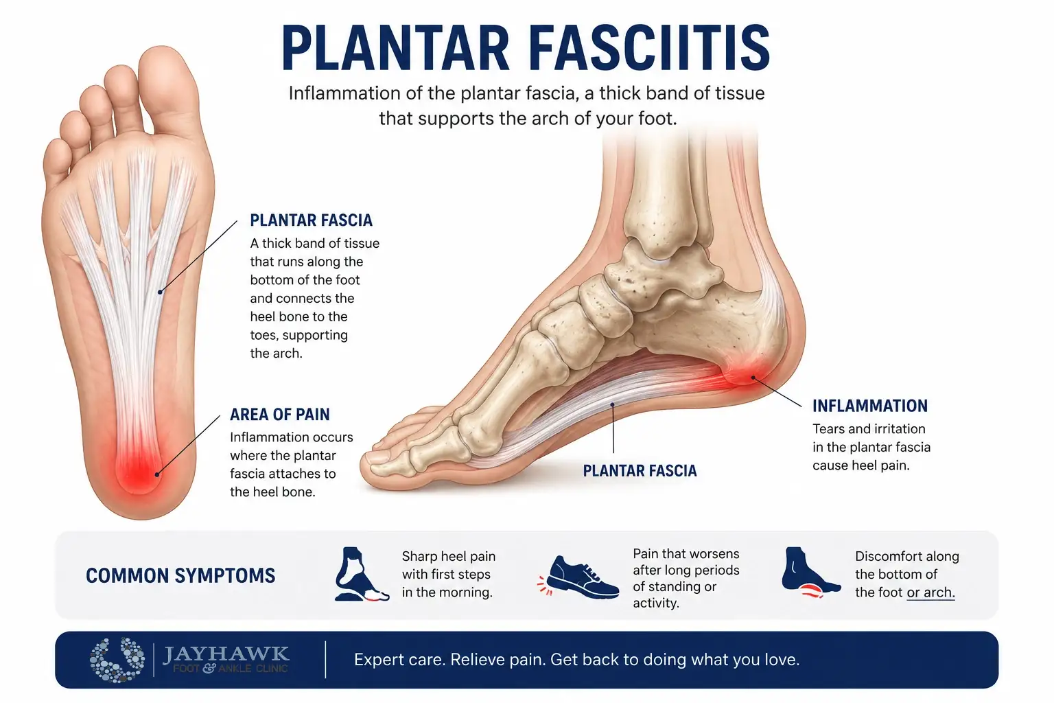 Medical diagram showing plantar fascia inflammation near the heel in plantar fasciitis